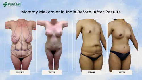 Mommy Makeover Plastic Surgery in India Before-After Results